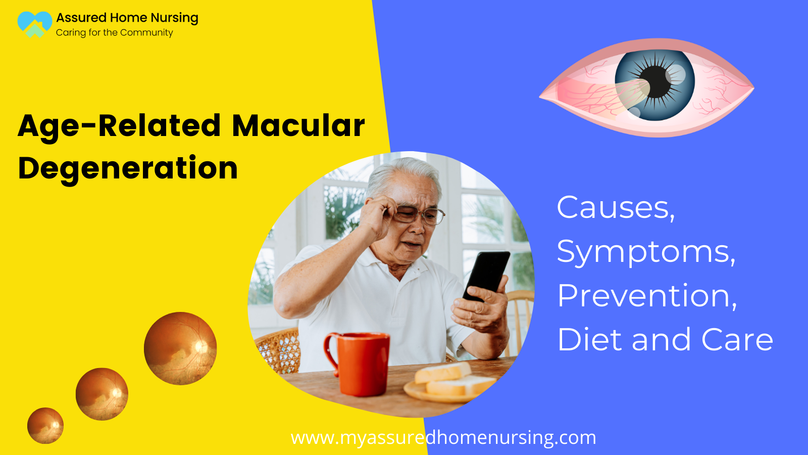 age related macular degeneration
